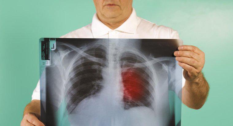 Evre Üç Akciğer Kanseri için Prognoz Nedir?