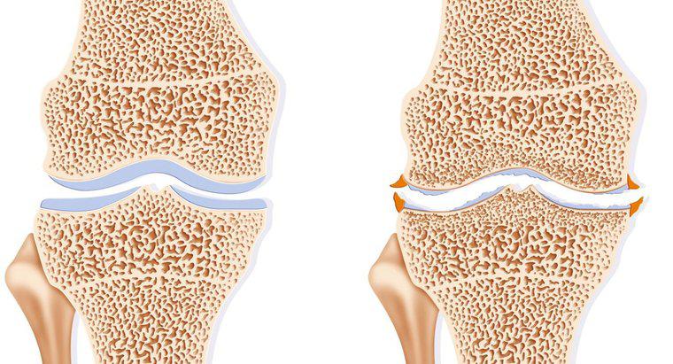 Osteofit Oluşumu Nedir?