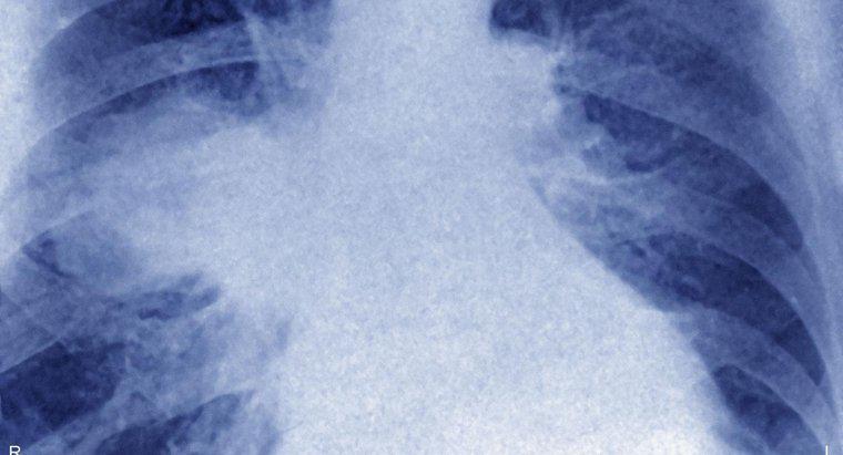 Akciğerlerin Lenfoması Nedir?