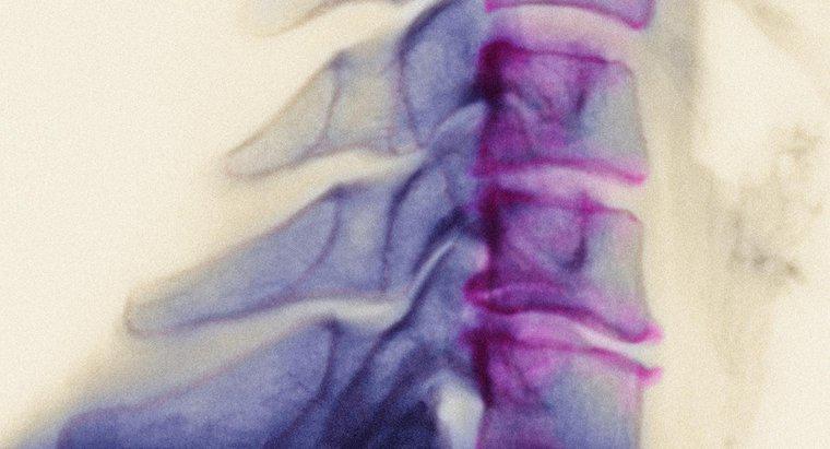 Osteofitik Yırtılma Nedir?