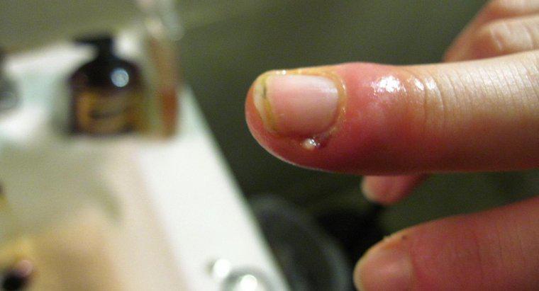 Kütikül Enfeksiyonundan Şişmiş Parmağı Olan Bir İnsan Ne Yapmalı?