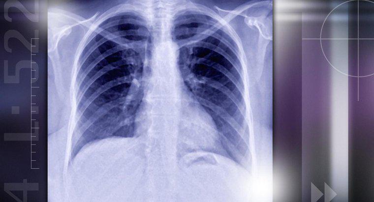 Akciğer Nodüllerinin Sebepleri Nedir?
