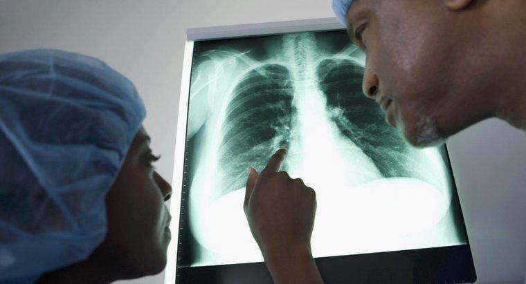 Akciğerlerde Sıvı İçin Farklı Tedavi Seçenekleri Nelerdir?