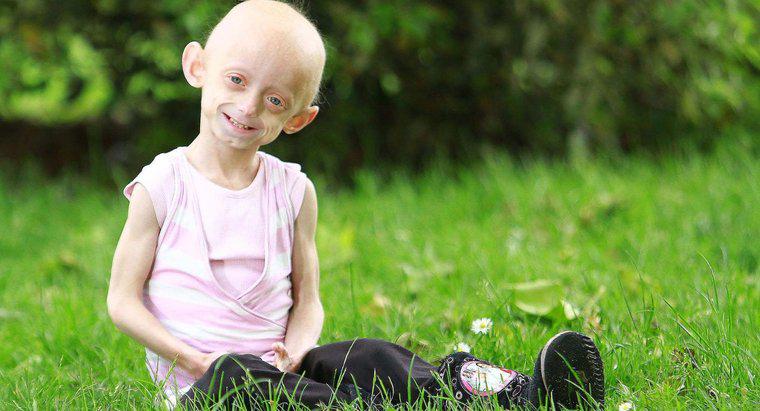 Progeria İle İlgili Bazı İlginç Gerçekler Nelerdir?