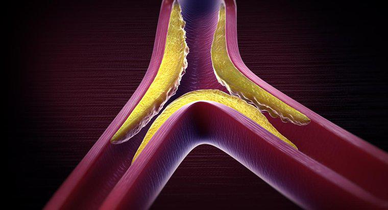 Karışık Hiperlipidemi Nedir?