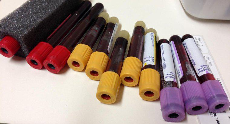 Kan Testi Ölçümünde Ferritin Düzeyleri Nelerdir?