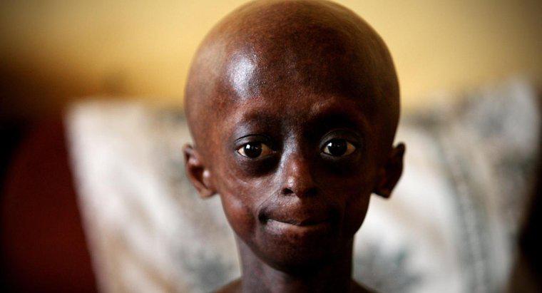 Progeria'lı Bir Kişinin Sınırlamaları Nedir?