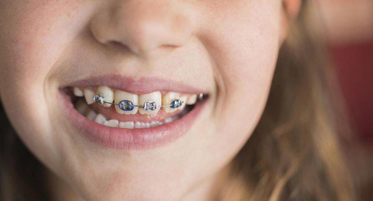 Diş telleri ile ilgili bazı iyi şakalar nelerdir?