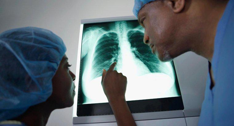 Akciğer Kanseri için Hangi Belirtiler Eşsizdir?
