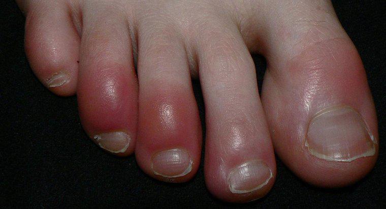 Red Toes Raynaud Sendromu'nun Bir Belirtisi midir?