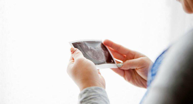 Fetal Kutup Nedir?