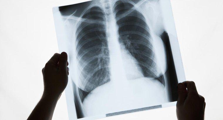 Akciğerlerde Beyaz Lekelerin Sebebi Nedir?