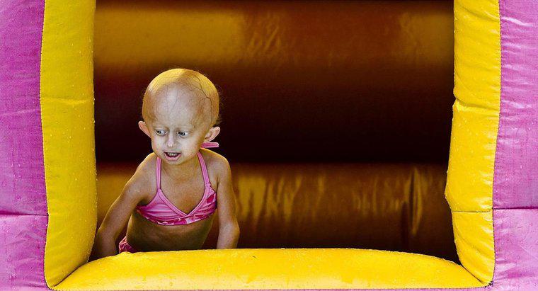 Progeria ile Ne Kadar Yaşayabilirsiniz?