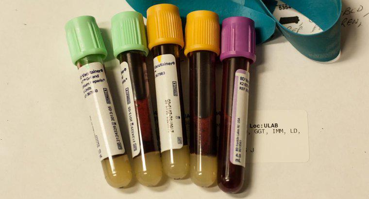 Yüksek Kan Amonyak Seviyelerini Nasıl Tedavi Edebilirsiniz?