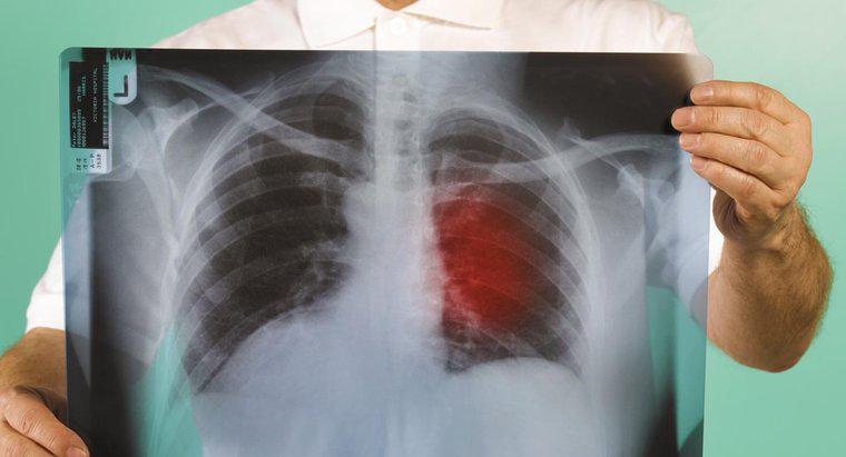 Akciğer Kanserinin İlk Belirtileri Nelerdir?
