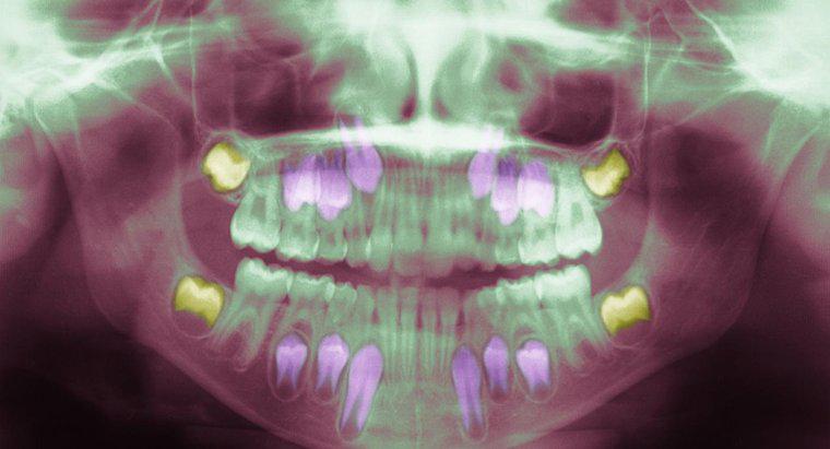 Bilgelik Diş Enfeksiyonuna Neden Olan Nedir?